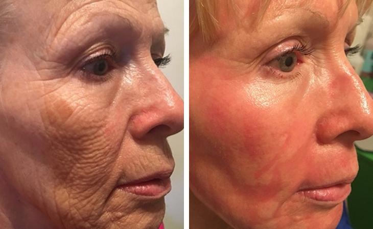 CO₂ Laser Full Face Rejuvenation